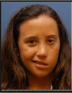 stroke_facial_paralysis